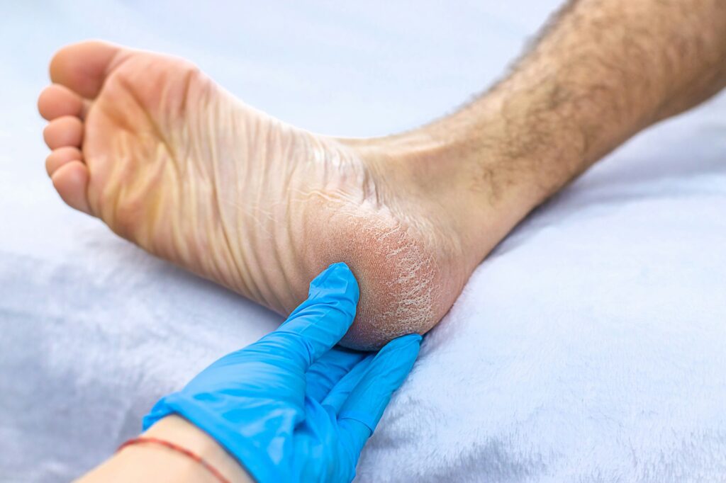 Male feet dry skin on the heels. Selective focus.