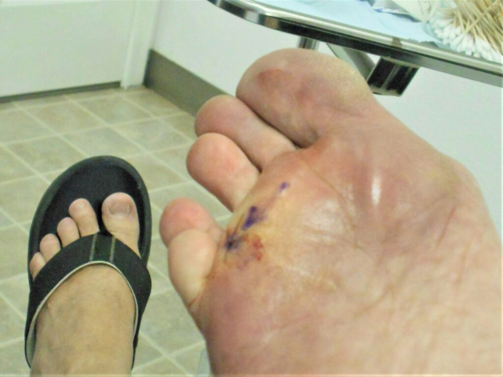 MELANOMA! Woman with Melanoma Skin Cancer on Her Foot Being Treated by Dermatologist!