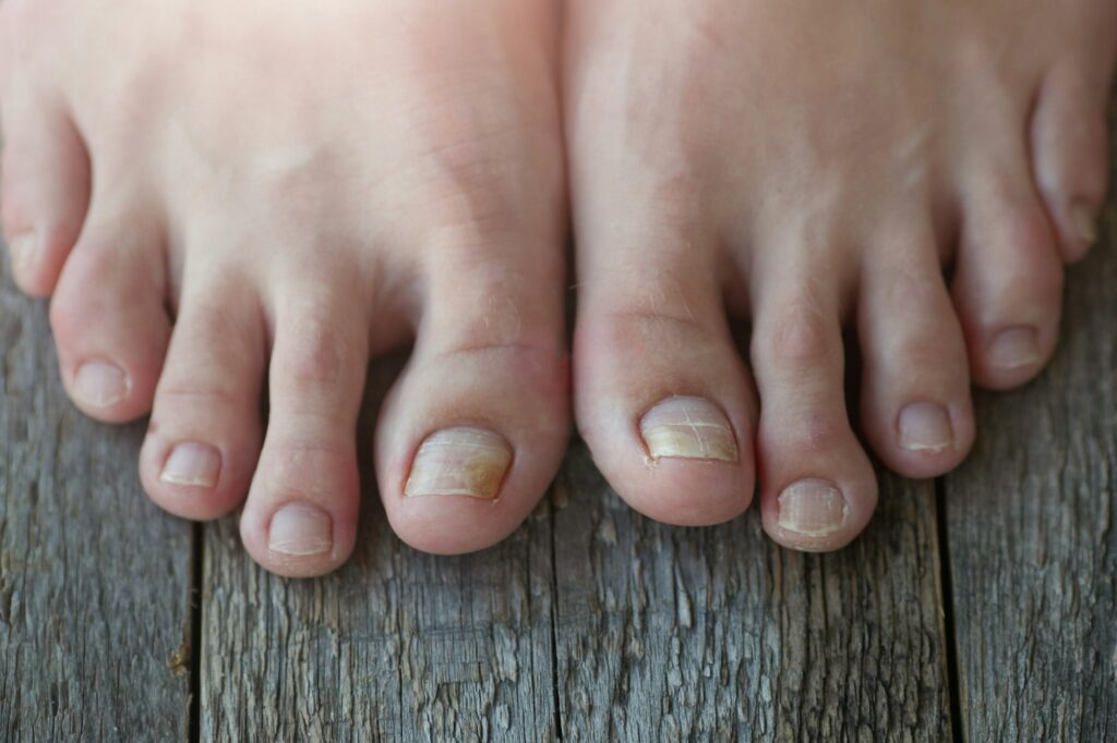 Why Are My Toenails So Ugly? Could It Be A Fungal Nail?