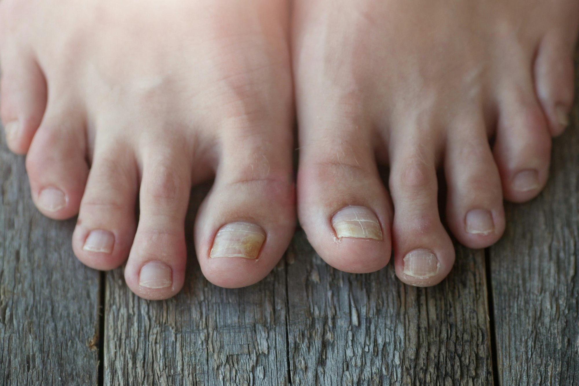 How to Clear Up Fungal Toenails Fast