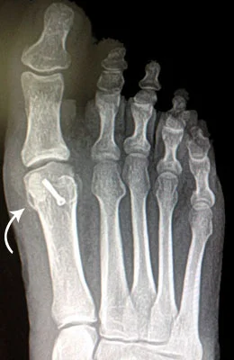 Hallux Limitus (Arthritis in the Big Toe Joint) after