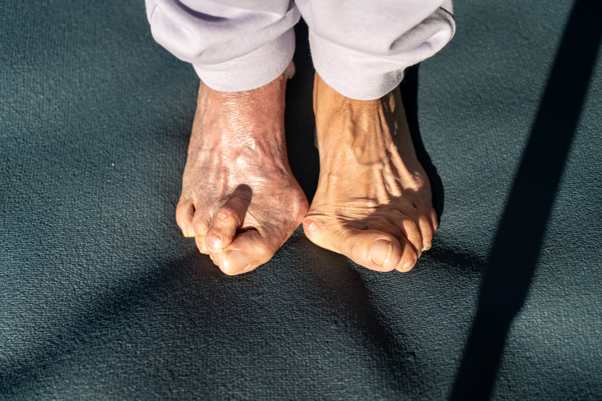 Four Telltale Symptoms of a Bunion