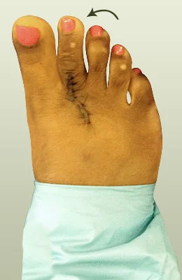 Plantar Plate Surgery after