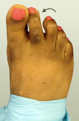 Plantar Plate Surgery before