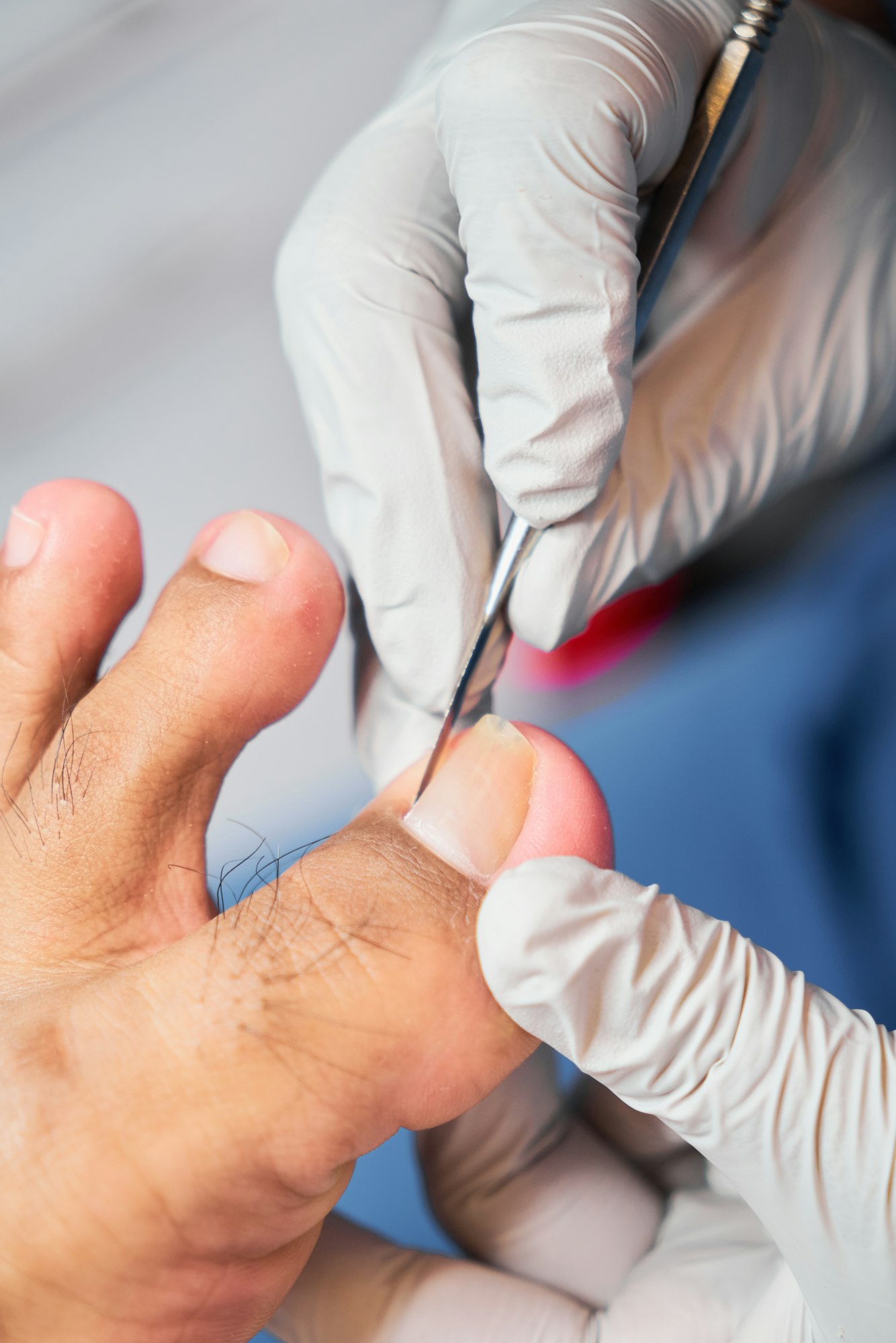 Podiatrist treating feet, Ingrown Toenail