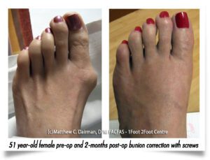 Bunion Before and After Photo
