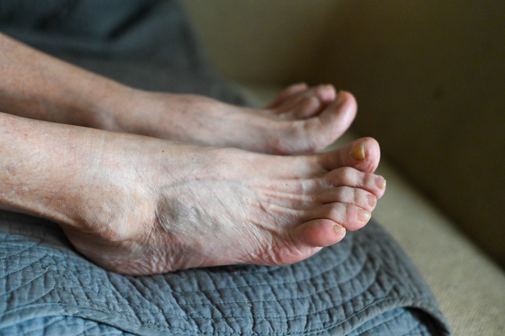 What’s the Difference Between Hammer Toe and Claw Toe?
