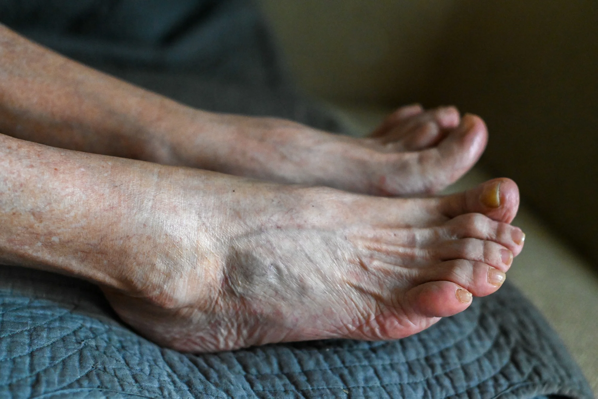 senior woman foot with medical condition, arthritis and fungus