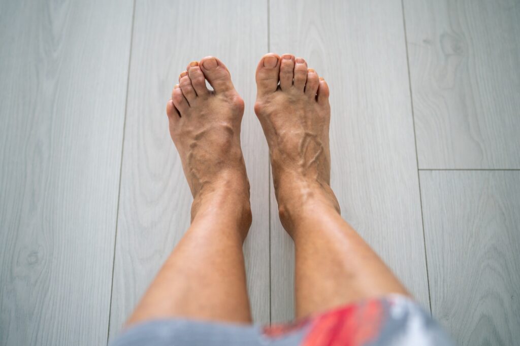 Surgery for Bunions