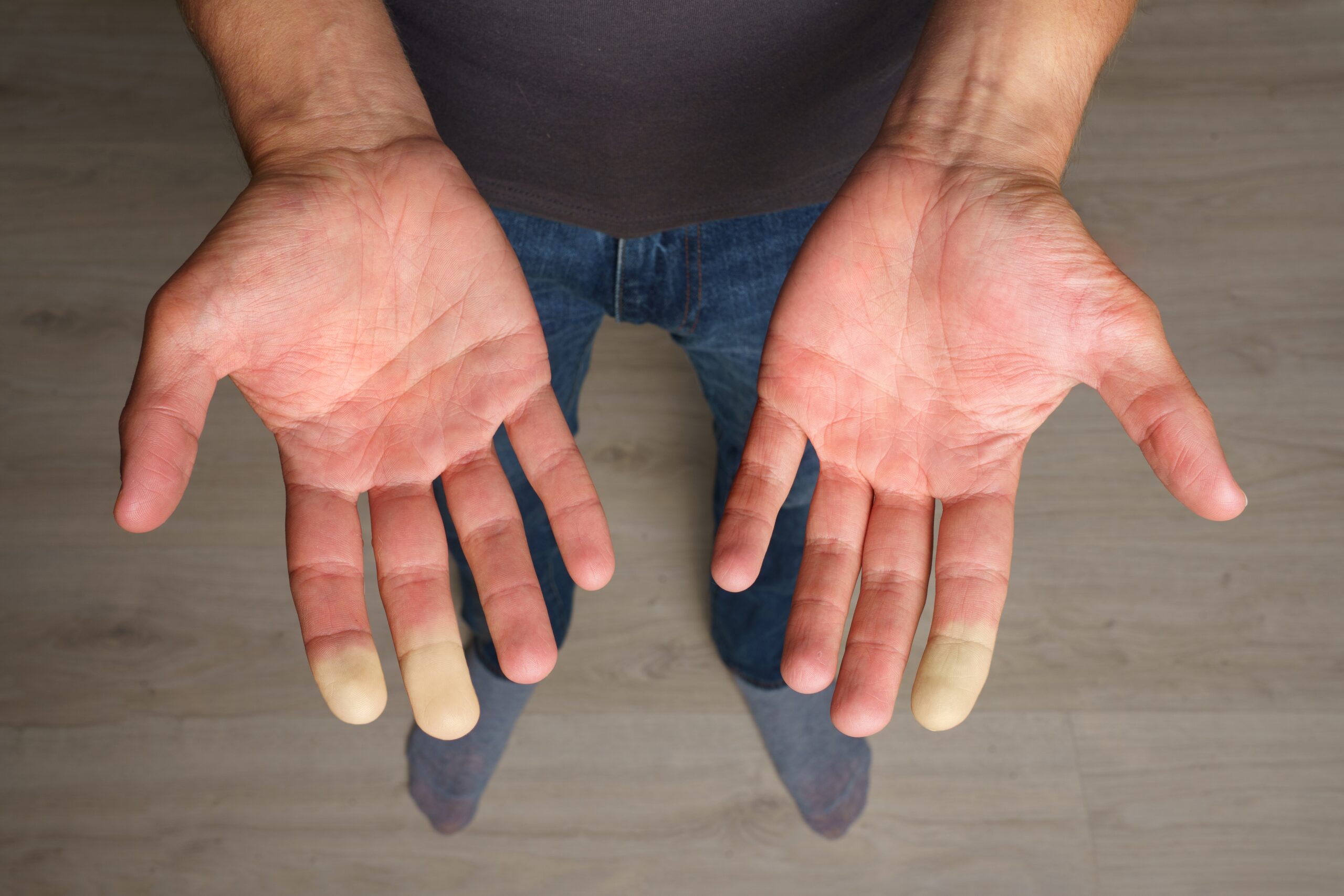 What Is Raynaud s Phenomenon 