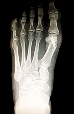Osteotomy Bunionectomy after