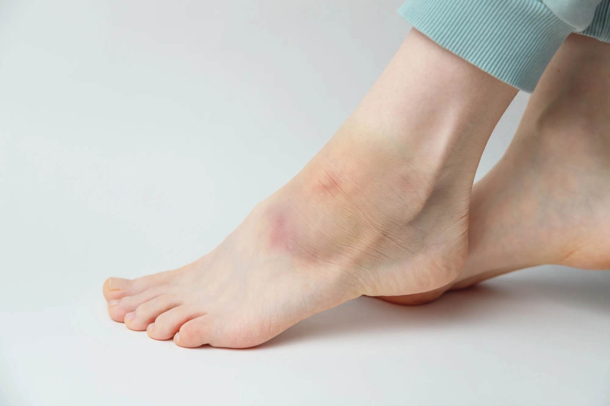 What is a Bone Bruise and Does it Need Treatment?