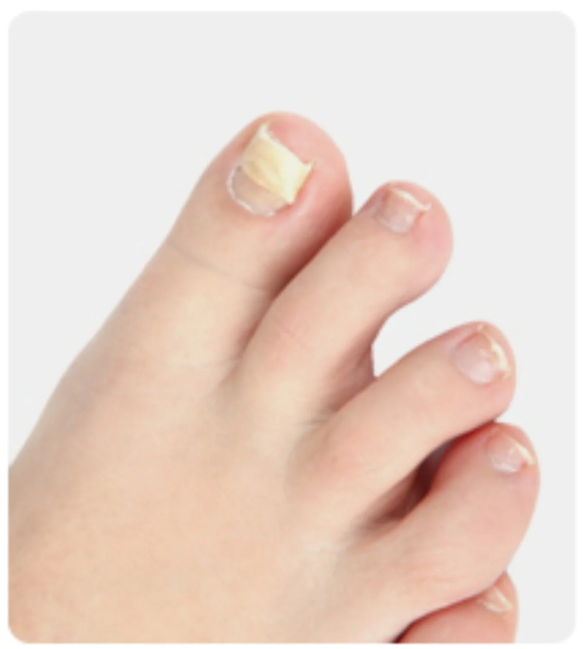 What Kind Of Doctor Deals With Toenail Fungus