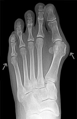 Tightrope Procedure and Osteotomy Tailors Bunion Surgery before