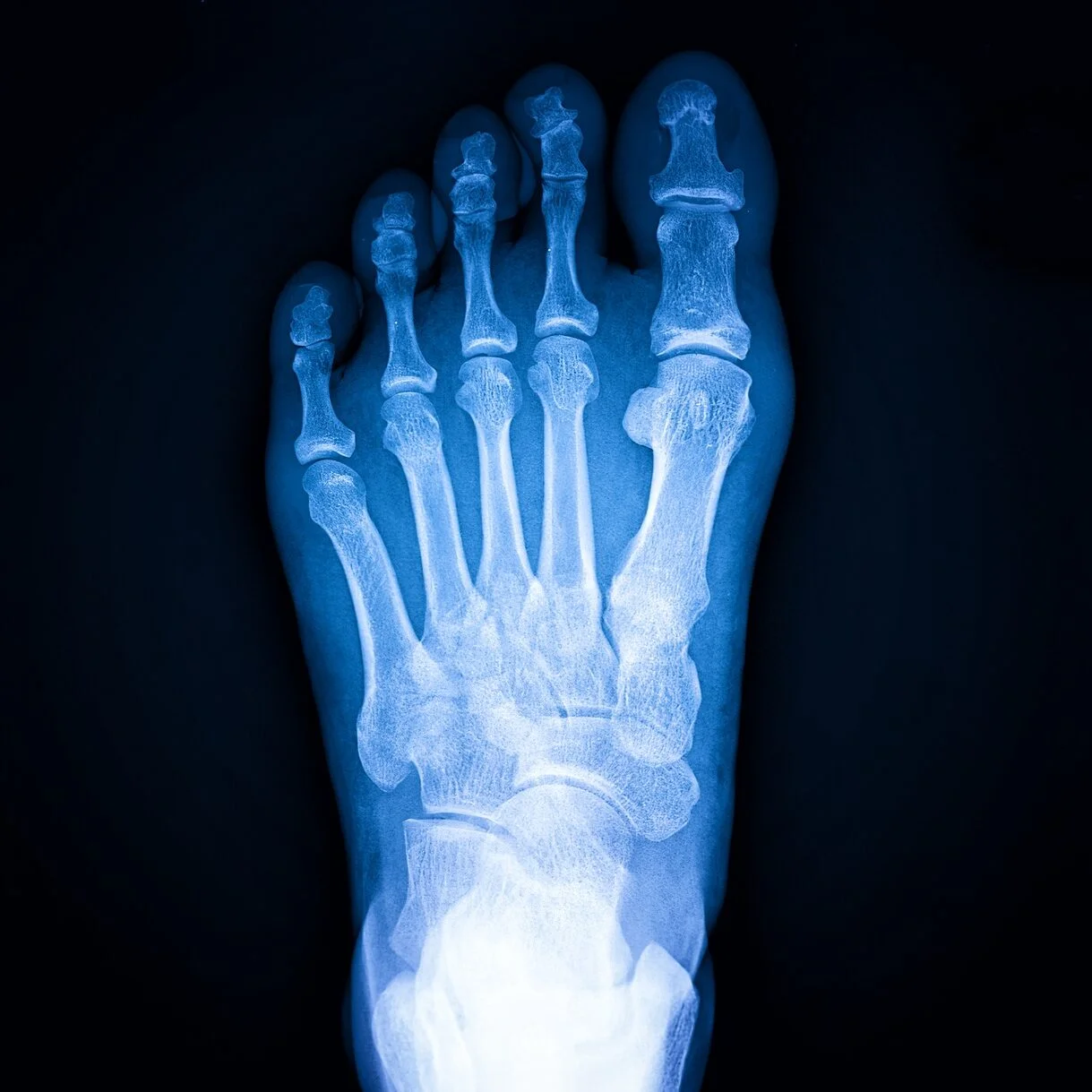 Navicular Radiograph Navicular Bone Anatomy Radiology