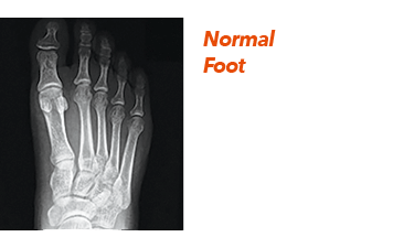 normal foot x-ray